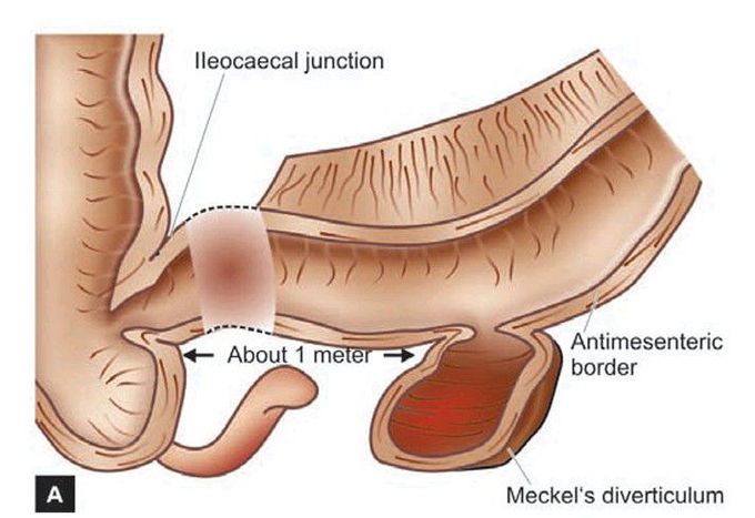 Meckel’s diverticulum.