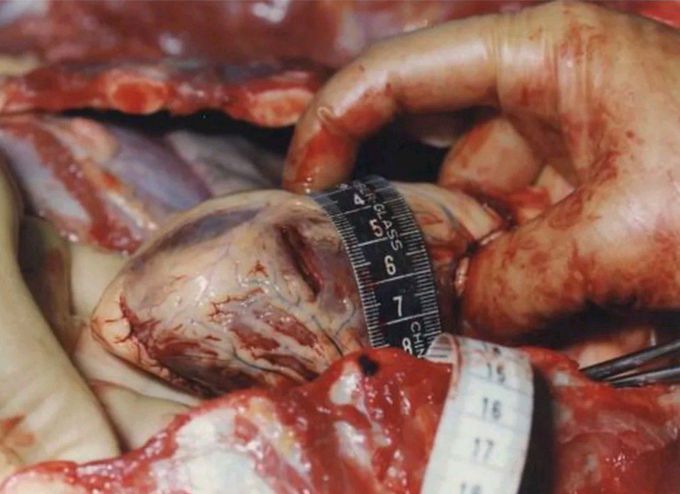 A stab wound to the heart