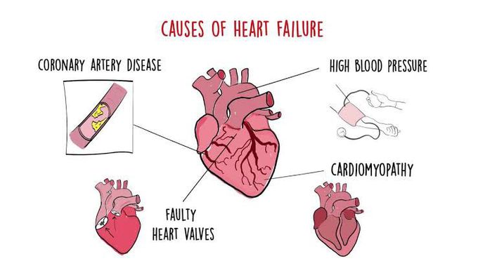 Causes of heart failure