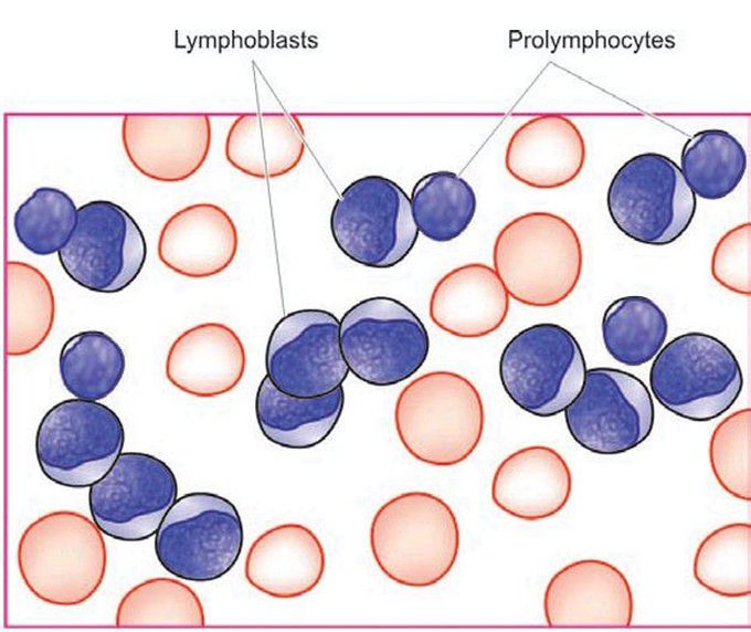 acute lymphoblastic leukaemia (ALL).