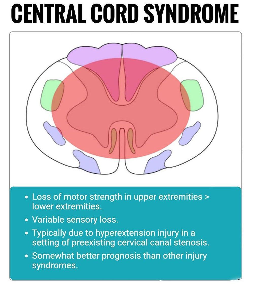 Central Cord Syndrome - MEDizzy