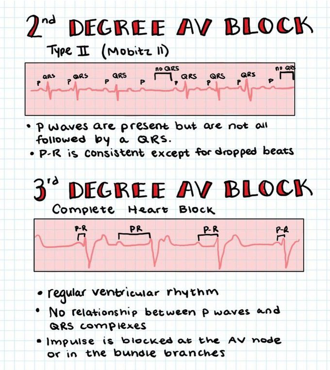 Heart Blocks III