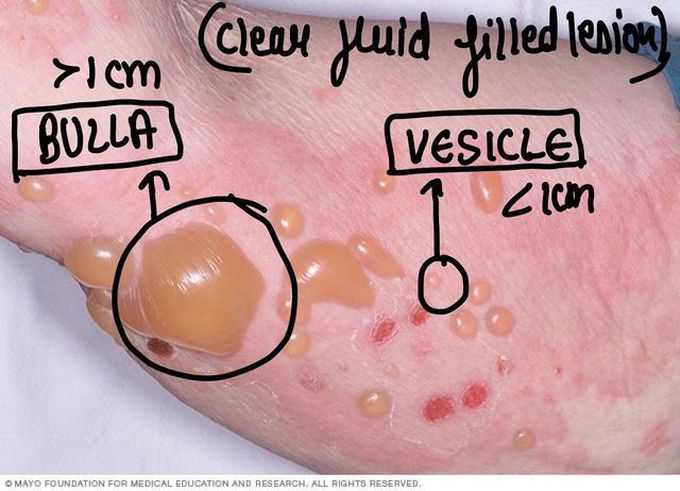 Bulla Vs Vesicle