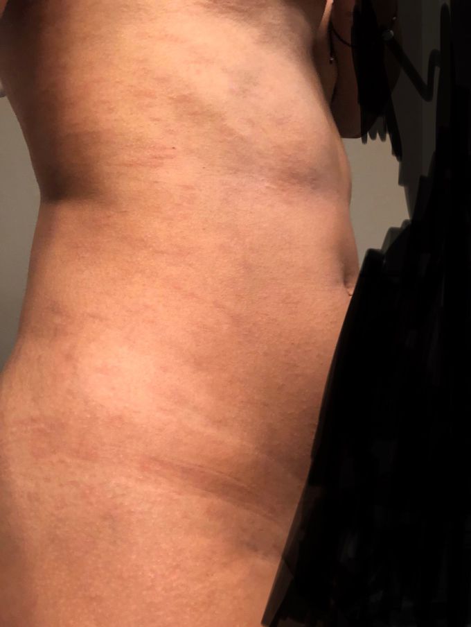 What is the name of this condition? Rash, female 42, 3 weeks .....