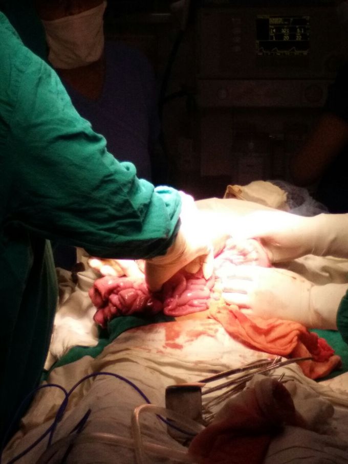 Appendectomy