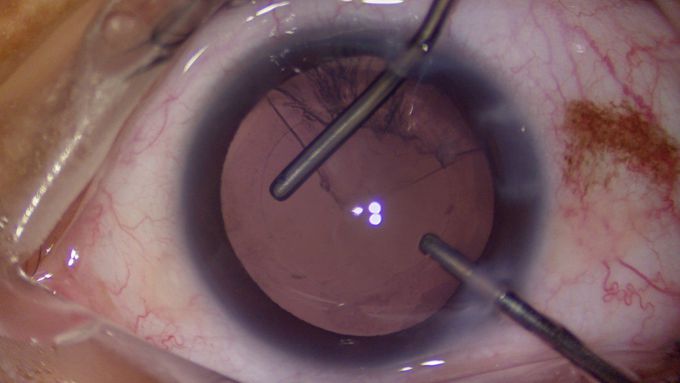 Cataract Surgery