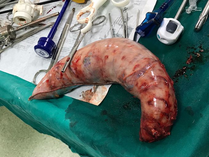Sleeve gastrectomy