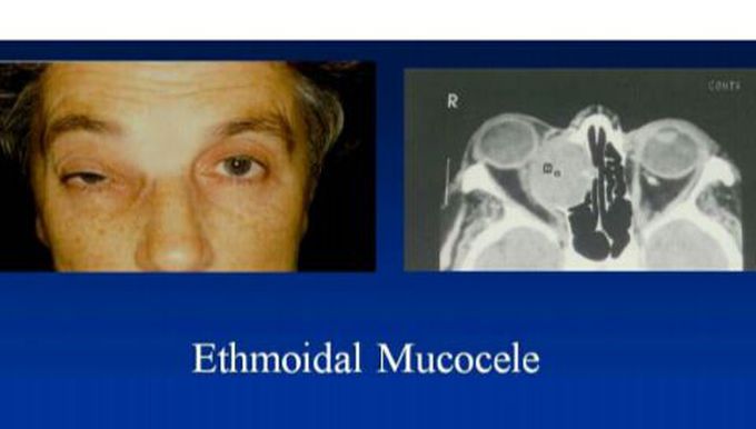 Ethmoidal mucocele