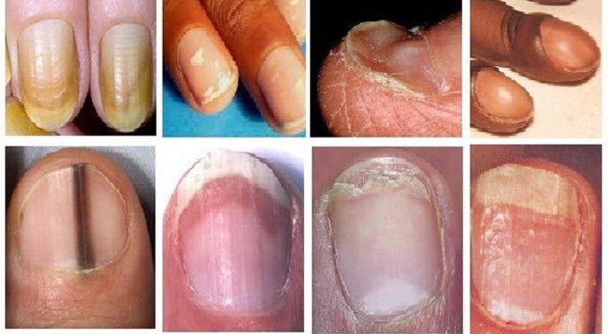 Nail Findings and Associated Systemic Conditions: