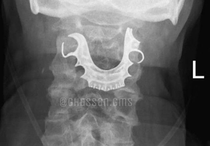 Partial Denture Swallowed