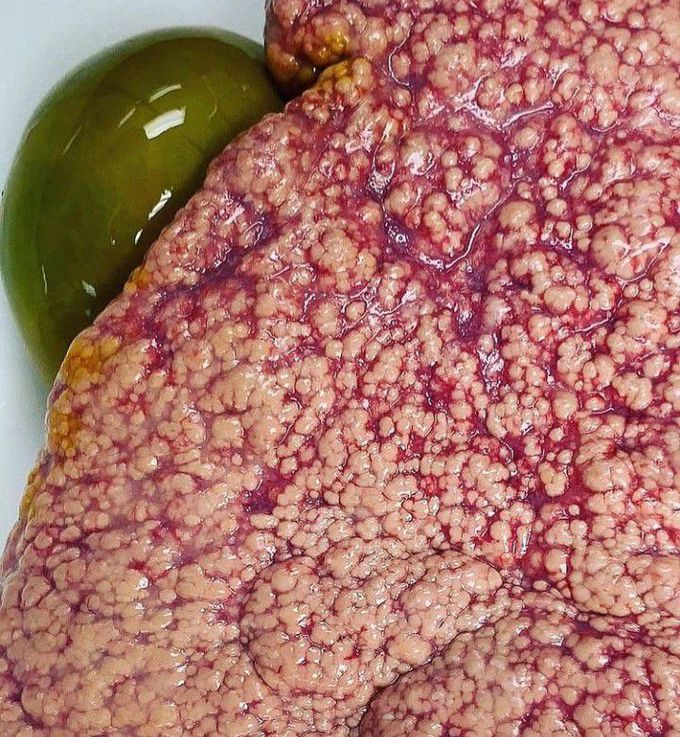 A classic example of Liver cirrhosis