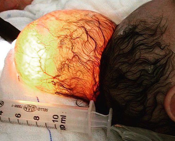 A preterm neonate with an abnormal sac protruding from his skull!