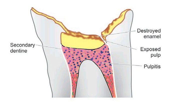 Dental caries.