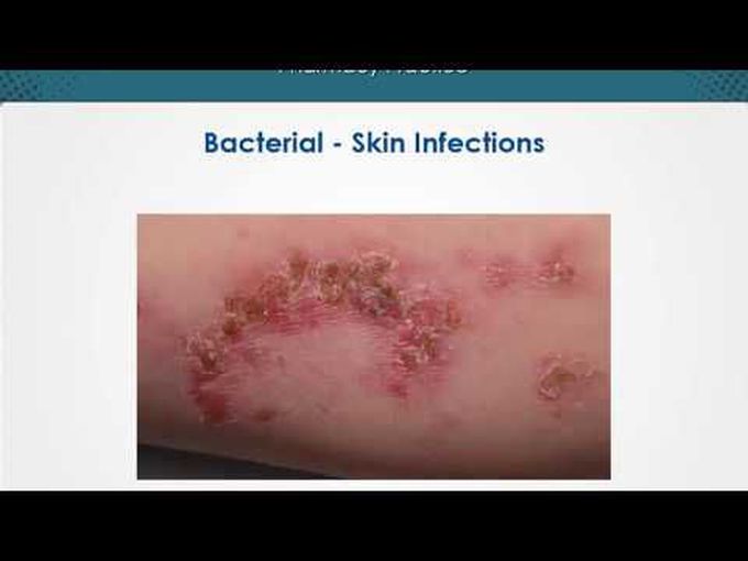 Pharmacological agents for Bacterial skin infections