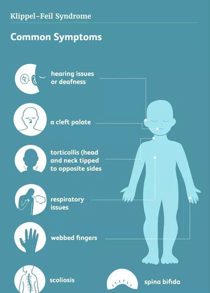 These are the symptoms of Klippel-fiel syndrome