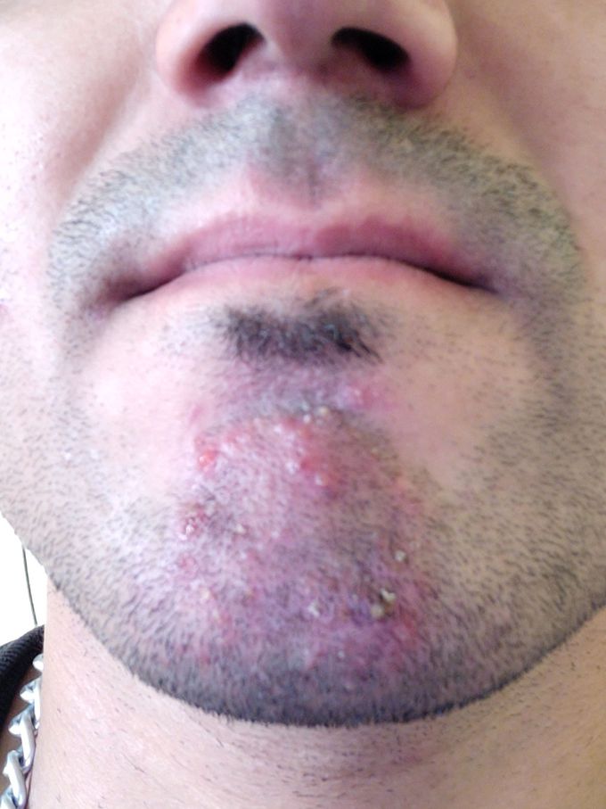 Pustular rash in chin and head