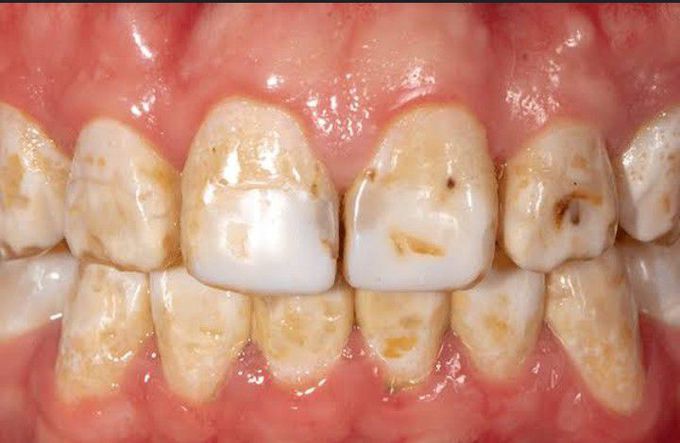 Dental fluorosis