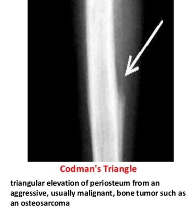 Codman's Triangle