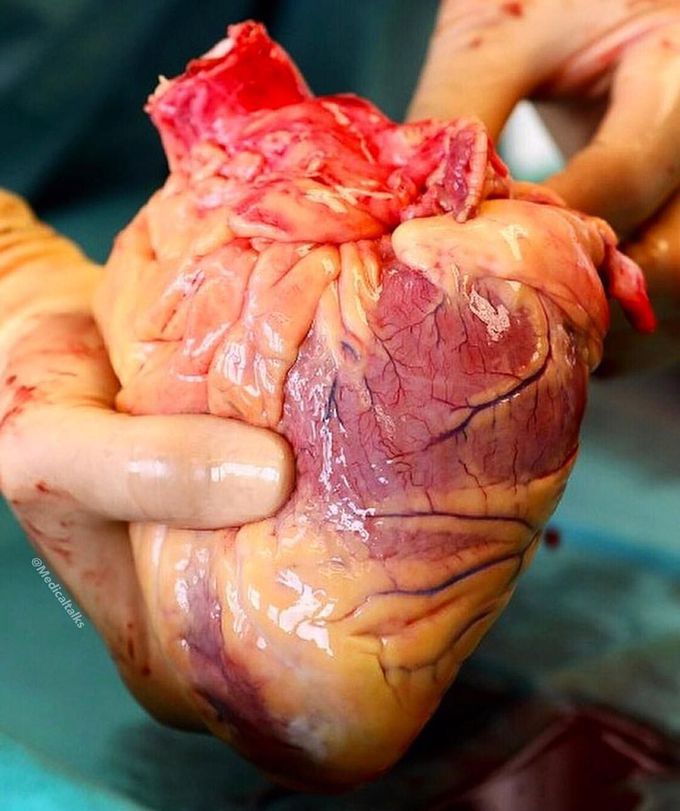 Donor heart prior to transplantation