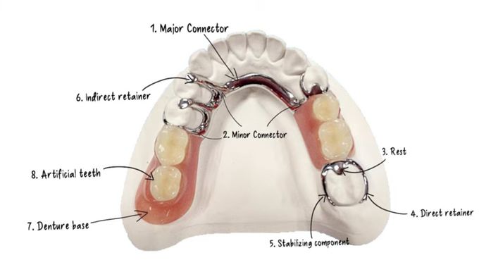 Components of RPD