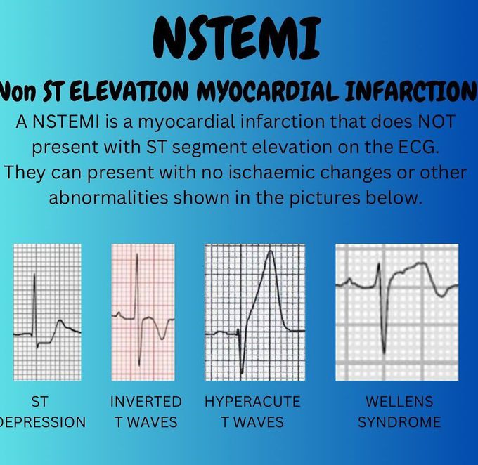 NSTEMI