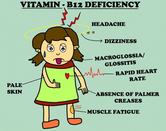 Vitamin-B12 deficiency