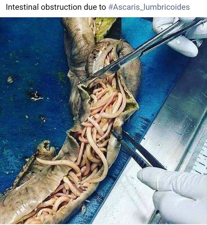 Ascaris Lumbricoides