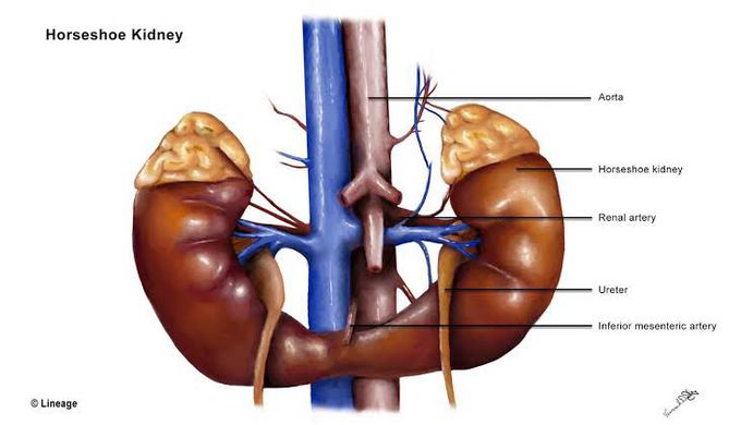 Horseshoe Kidney