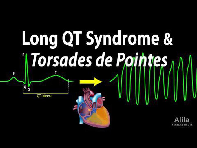 Long QT syndrome and Torsade De Pointes
