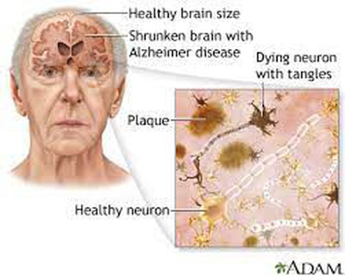 Alzheimer’s Disease Causes