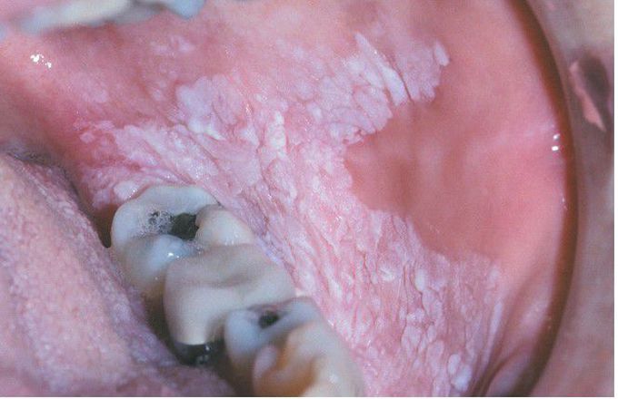 Homogeneous or Thick Leukoplakia