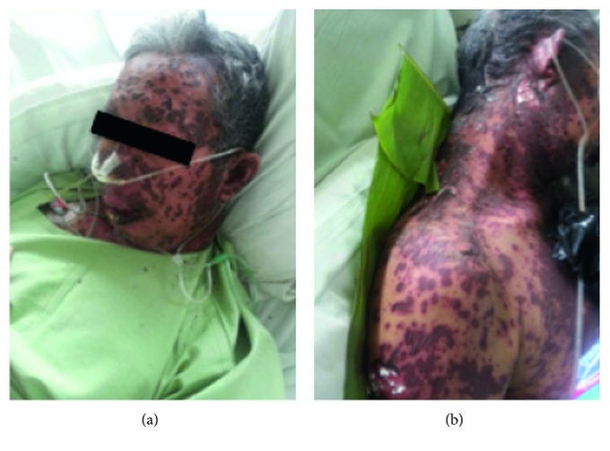 Methampyrone-Induced Toxic Epidermal Necrolysis
