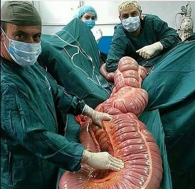 Toxic megacolon...