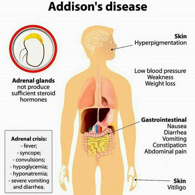 Addison's Disease