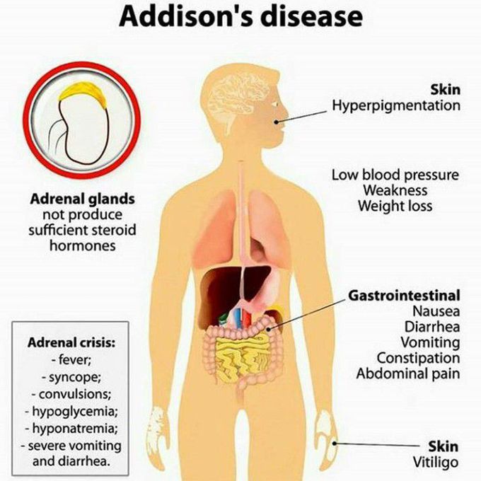 Addison S Disease MEDizzy   1ddb57bc Ce7e 4fb6 9b57 Bcce7e8fb6cc