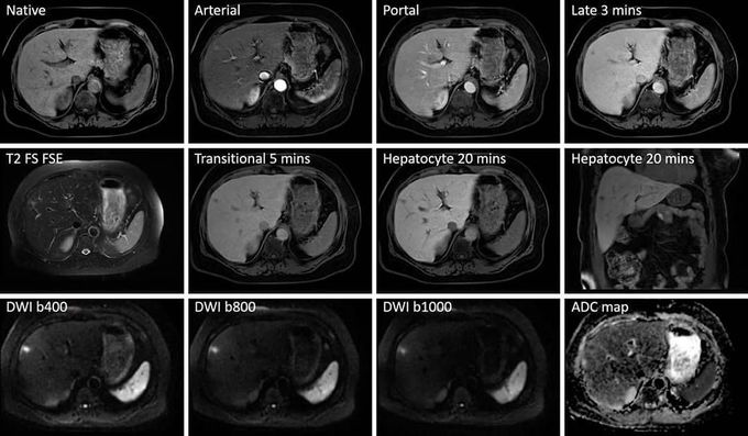 MR Imaging of small Liver metastasis