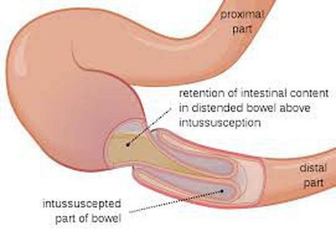 Intussusception