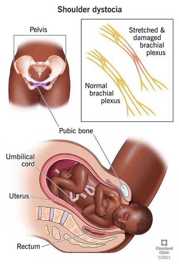 How is shoulder dystocia diagnosed?