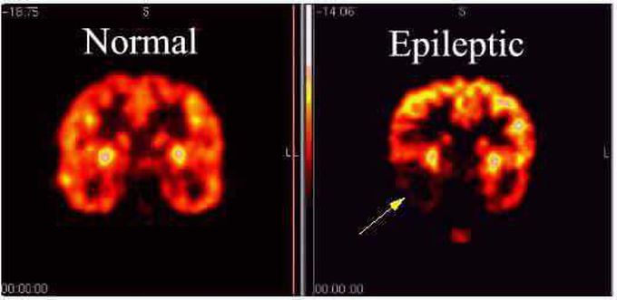 Epileptic
