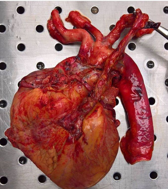  Internal Thoracic Artery