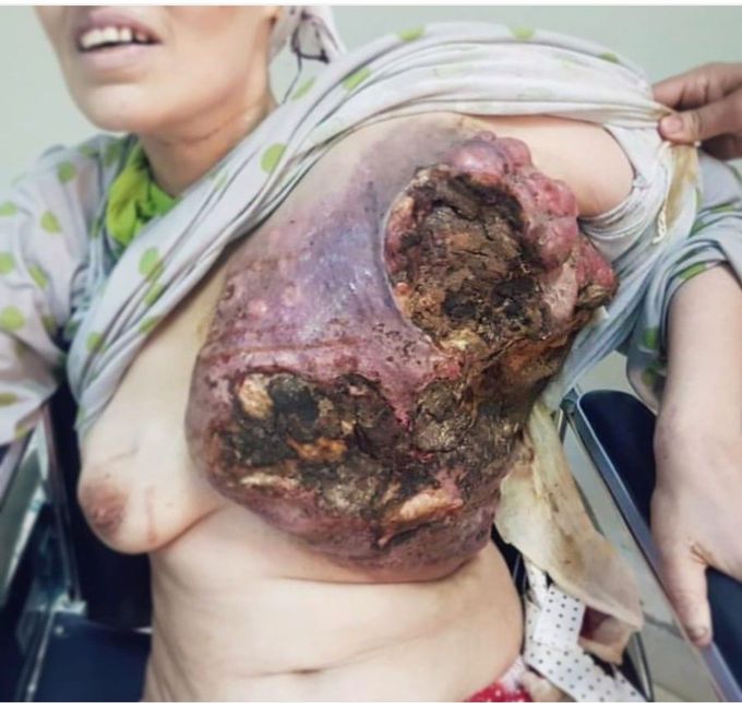 Breast Cancer