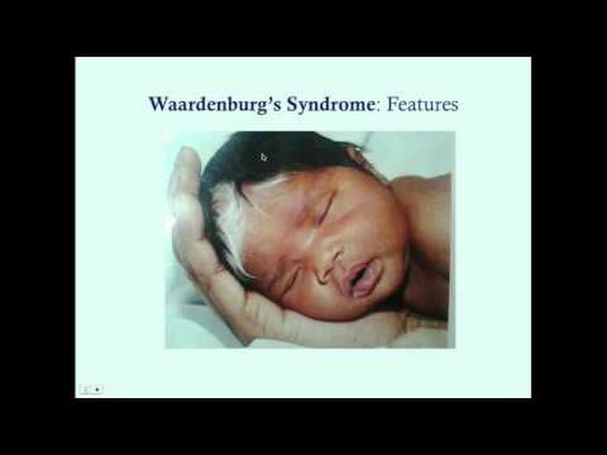 Waardenburg Syndrome-Neurocristopathies