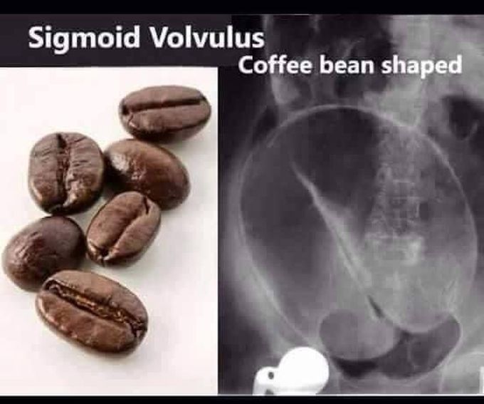 Sigmoid volvulus Radiography