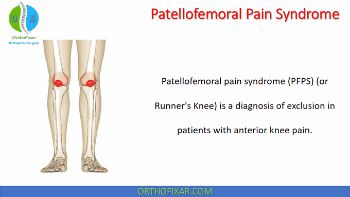 Patellofemoral Pain Syndrome • Easy Explained - OrthoFixar 2022