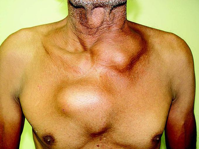 Chest wall swellings