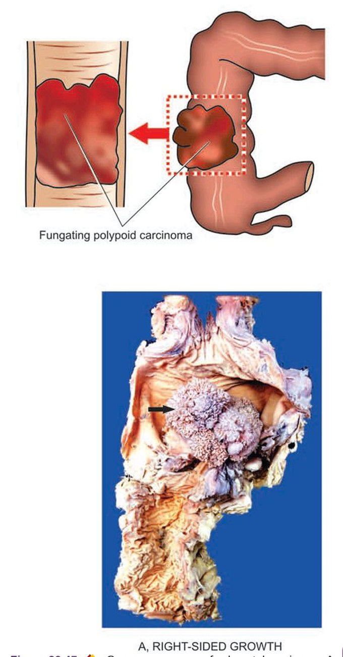 Colorectal carcinoma