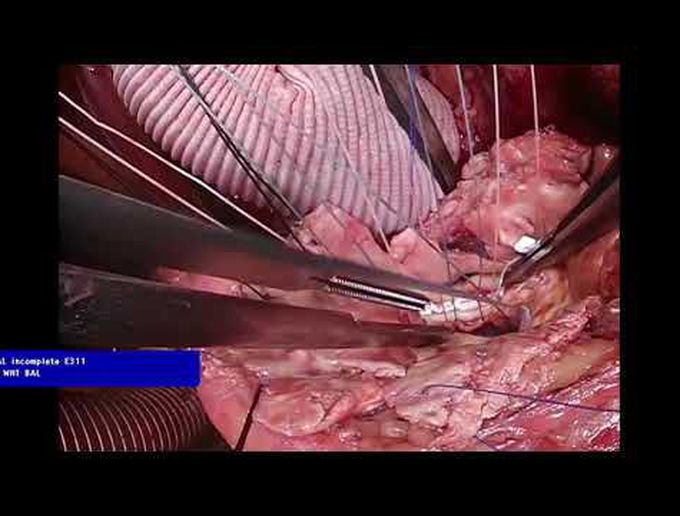 Redo Total Arch and Root Replacement