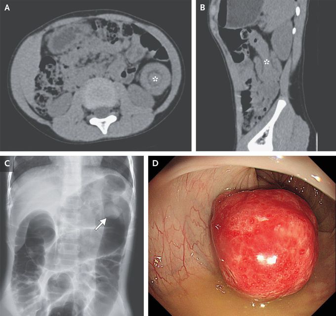 Colocolonic Intussusception