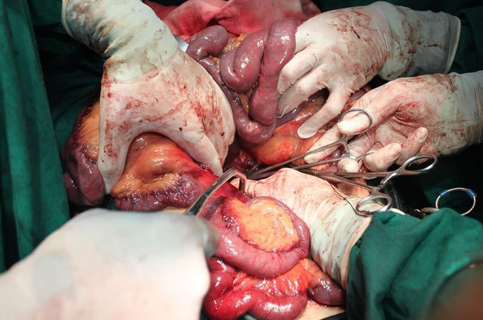 Four degrees of intra-operative haemorrhage