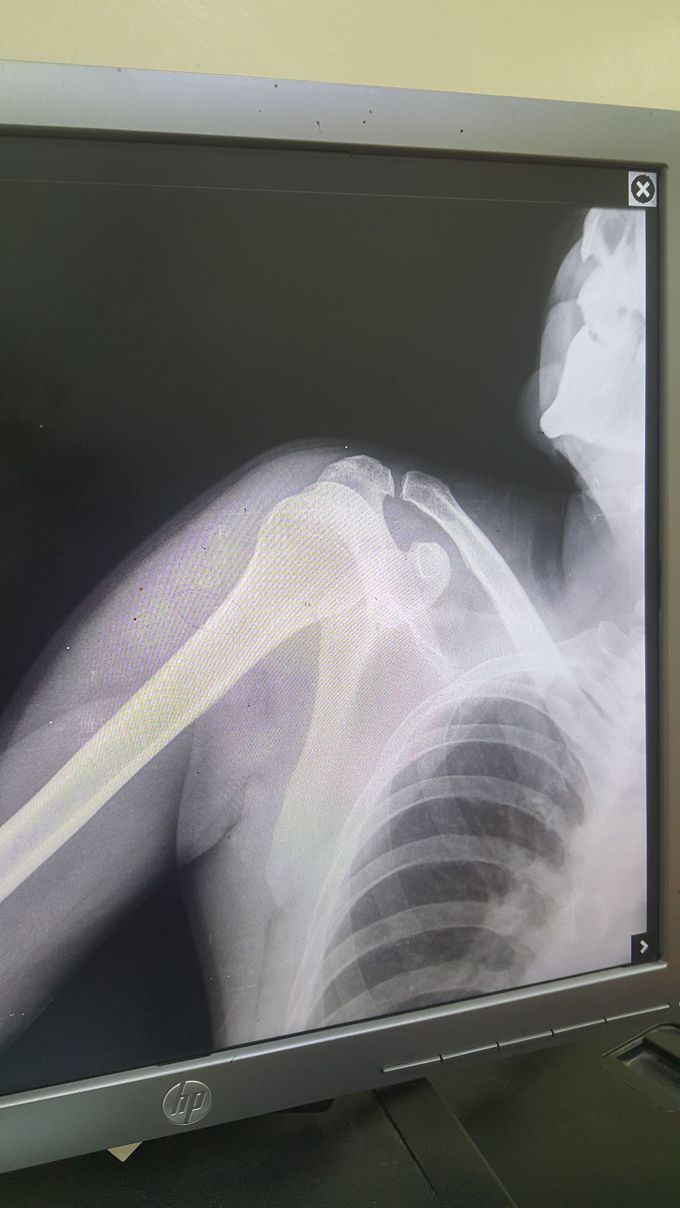 Clavicle fracture